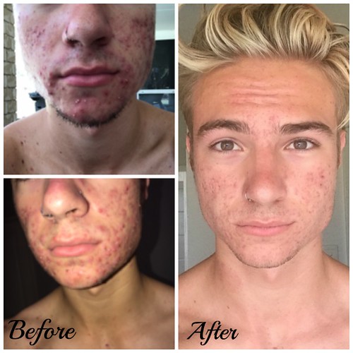 Before and after photos of acne improvement